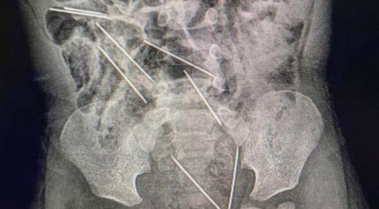 Niño de 2 años tragó ocho agujas hipodérmicas: médicos logran salvarlo