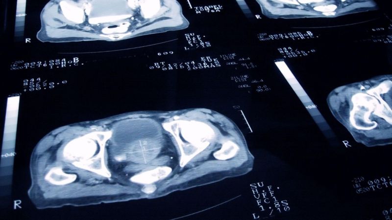 El estudio que revela que el cáncer de próstata se puede curar con menos sesiones de radioterapia (y el “enorme cambio” que significa en el tratamiento de la enfermedad)